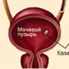 Так ли страшна мочекаменная болезнь?